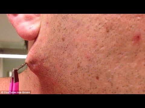 Bullpen reccomend Ingrown facial hairs removal