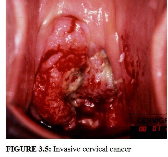 FUBAR reccomend Cervix and vagina squamous cells