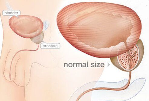 best of In blood Calculi sperm