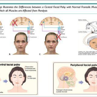 Multiple sclerosis facial paralysis